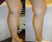 Picture of Varicose Veins and after treatment