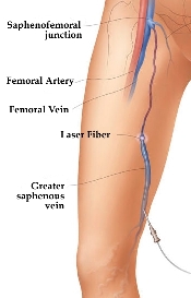 Varicose Veins Procedure illustration